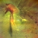 Proliferative Diabetic Retinopathy Proliferative Diabetic Retinopathy