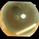 Intravitreal Implant Migration into AC