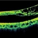 Bilateral Myopic Foveoschisis