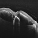 New Subretinal Hemorrhage in AMD New Subretinal Hemorrhage in AMD