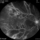 Combined Central Retinal Artery and Vein Occlusion Combined Central Retinal Artery and Vein Occlusion