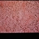 Neurofibroma Pathology Slide Neurofibroma Pathology Slide