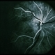 Congenital Disc Anomaly Congenital Disc Anomaly