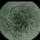Venous Stasis Retinopathy Venous Stasis Retinopathy
