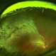 Commotio Retinae