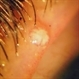 Molluscum Contagiosum Molluscum Contagiosum