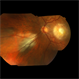 Choroidal Nevus Myelinated Nerve Fiber Layer Choroidal Nevus Myelinated Nerve Fiber Layer