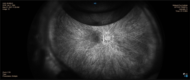 Gas Bubble Retina Image Bank