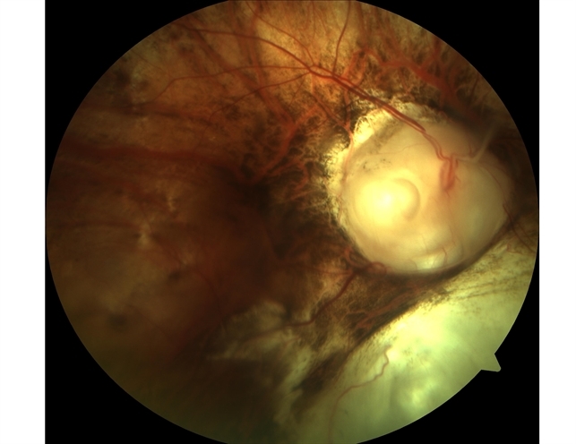 Optic Disc Pit Associated with Optic Disc Coloboma and Retinochoroidal