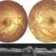 X LINKED RETINOSCHISIS X LINKED RETINOSCHISIS