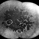 Rod Cone dystrophy Rod Cone dystrophy