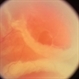 Outer Layer Holes with Rolled Edges in Retinoschisis Outer Layer Holes with Rolled Edges in Retinoschisis
