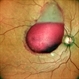 Pre-Retinal Hemorrhage Pre-Retinal Hemorrhage