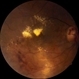 Clinically Significant Macular Edema Clinically Significant Macular Edema