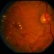 BDR / Macular Edema / Macroaneurysm BDR / Macular Edema / Macroaneurysm