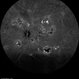 Multifocal Exudative Detachments Due to VKH Multifocal Exudative Detachments Due to VKH