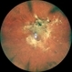 TRACTIONAL RETINAL DETACHMENT TRACTIONAL RETINAL DETACHMENT
