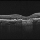 Geographic Atrophy in Dry AMD Geographic Atrophy in Dry AMD