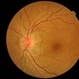 ANGIOID STREAKS