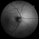 Autofluorescence in Optic Nerve Head Drusen Autofluorescence in Optic Nerve Head Drusen