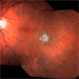 Repaired Retinal Macroaneurysm