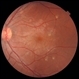 Autosomal Recessive Bestrophinopathy Autosomal Recessive Bestrophinopathy