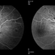 Diabetic Retinopathy Optic Nerve Edema, Fluorescein Angiogram, Stereo