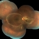 Perimacular Fold in Terson's Syndrome Perimacular Fold in Terson's Syndrome