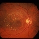 Dry AMD Dry AMD