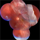 Retinal Detachment  with Giant Tear