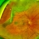 Giant Retinal Tear Giant Retinal Tear