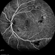Multifocal Exudative Detachments Due to VKH Multifocal Exudative Detachments Due to VKH
