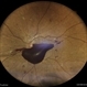 Subhyaloid Hemorrhage in a Case of Proliferative Diabetic Retinopathy Subhyaloid Hemorrhage in a Case of Proliferative Diabetic Retinopathy
