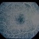 Ring 17 Chromosome Ring 17 Chromosome