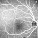 Idiopathic Juxtafoveal Telangiectasia, Type 2