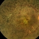 Retinitis Pigmentosa Retinitis Pigmentosa