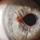 Iris Nevus Iris Nevus