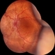 Hypotonic Maculopathy Following Glaucoma Surgery Hypotonic Maculopathy Following Glaucoma Surgery