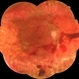 Proliferative Diabetic Retinopathy