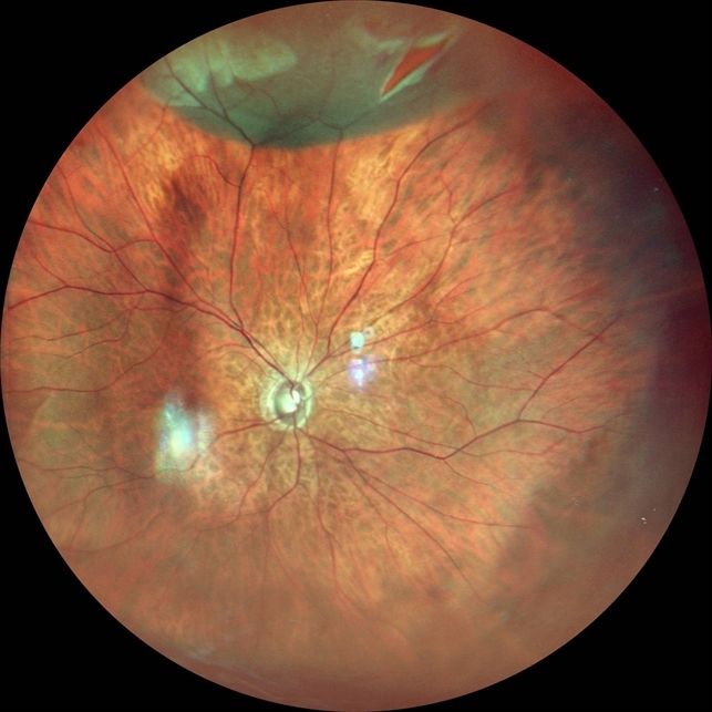 Retinal Detachment With Horseshoe Tear Retina Image Bank