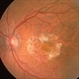 Fibrous Scaring After Laser Photocoagulation Fibrous Scaring After Laser Photocoagulation