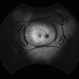 4 Point Scleral Fixation Akreos AO60 With Gore Tex Suture 4 Point Scleral Fixation Akreos AO60 With Gore Tex Suture