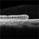 Macular Hole and Retinoschisis in Goldmann - Favre Syndrome Macular Hole and Retinoschisis in Goldmann - Favre Syndrome