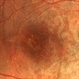 DUSN (Diffuse Unilateral Subacute Neuroretinitis) DUSN (Diffuse Unilateral Subacute Neuroretinitis)