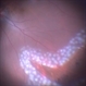 Retinal Detachment and Retinal Tear Treated with Laser Retinal Detachment and Retinal Tear Treated with Laser