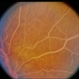 Hyperlipidemia