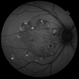 Autosomal Recessive Bestrophinopathy Autosomal Recessive Bestrophinopathy