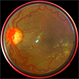 Retinal Hemangioblastoma Retinal Hemangioblastoma