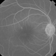 Tamoxifen Retinopathy  Pseudocystic Foveal Cavitatio - FA Late