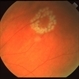 Operculated Retinal Tear Operculated Retinal Tear